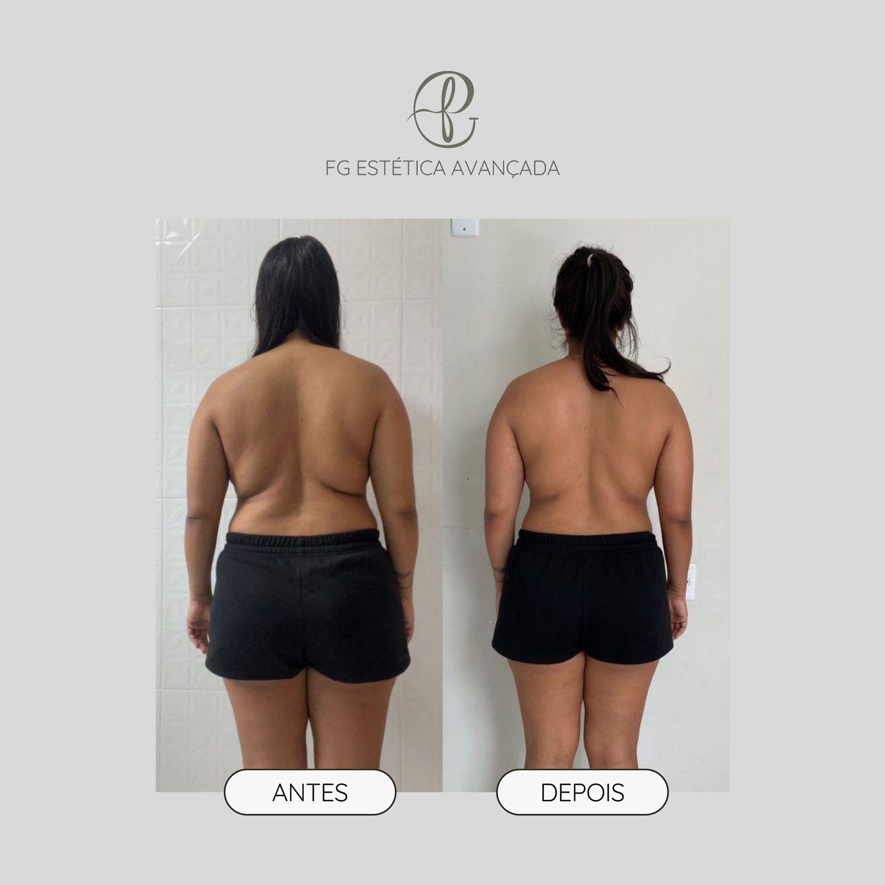 Resultado antes e depois de aplicação de enzimas — gordura localizada nas costas