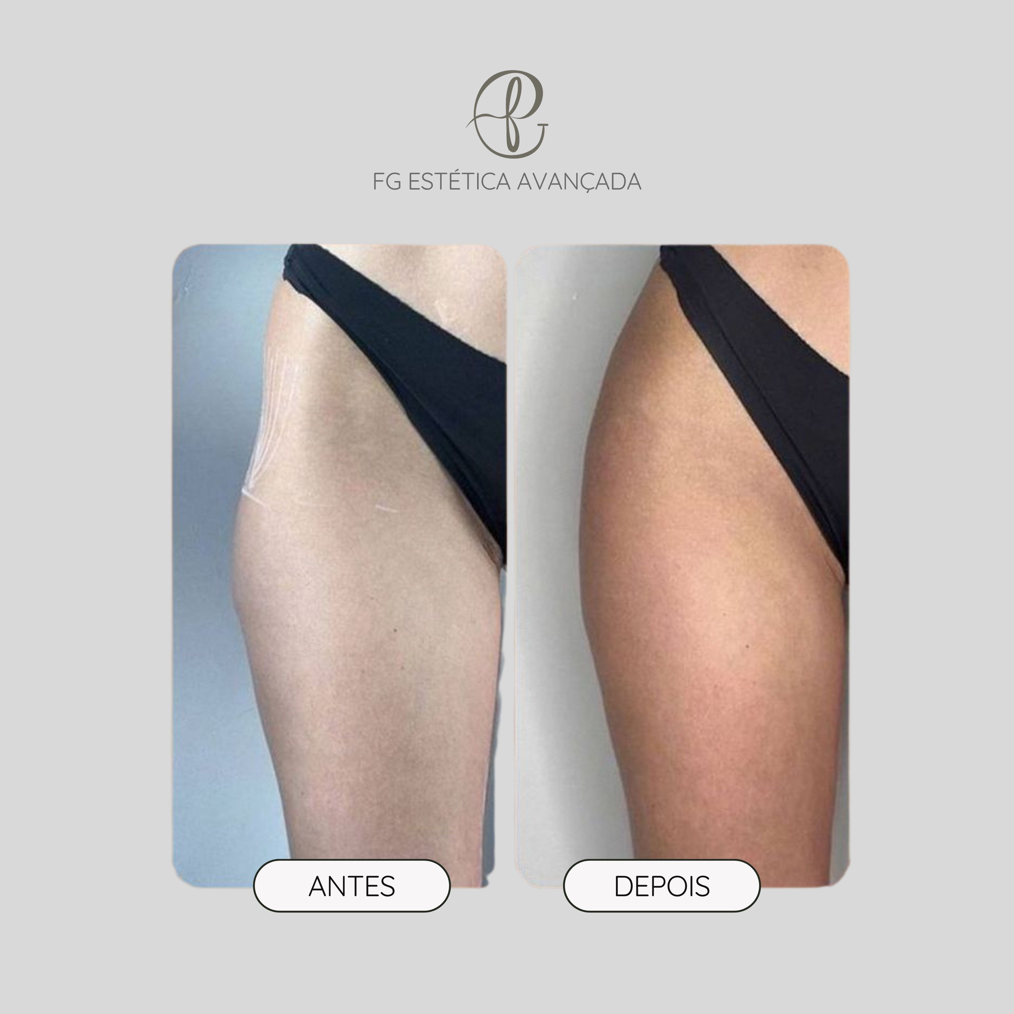 Resultado antes e depois do protocolo Glúteo Max