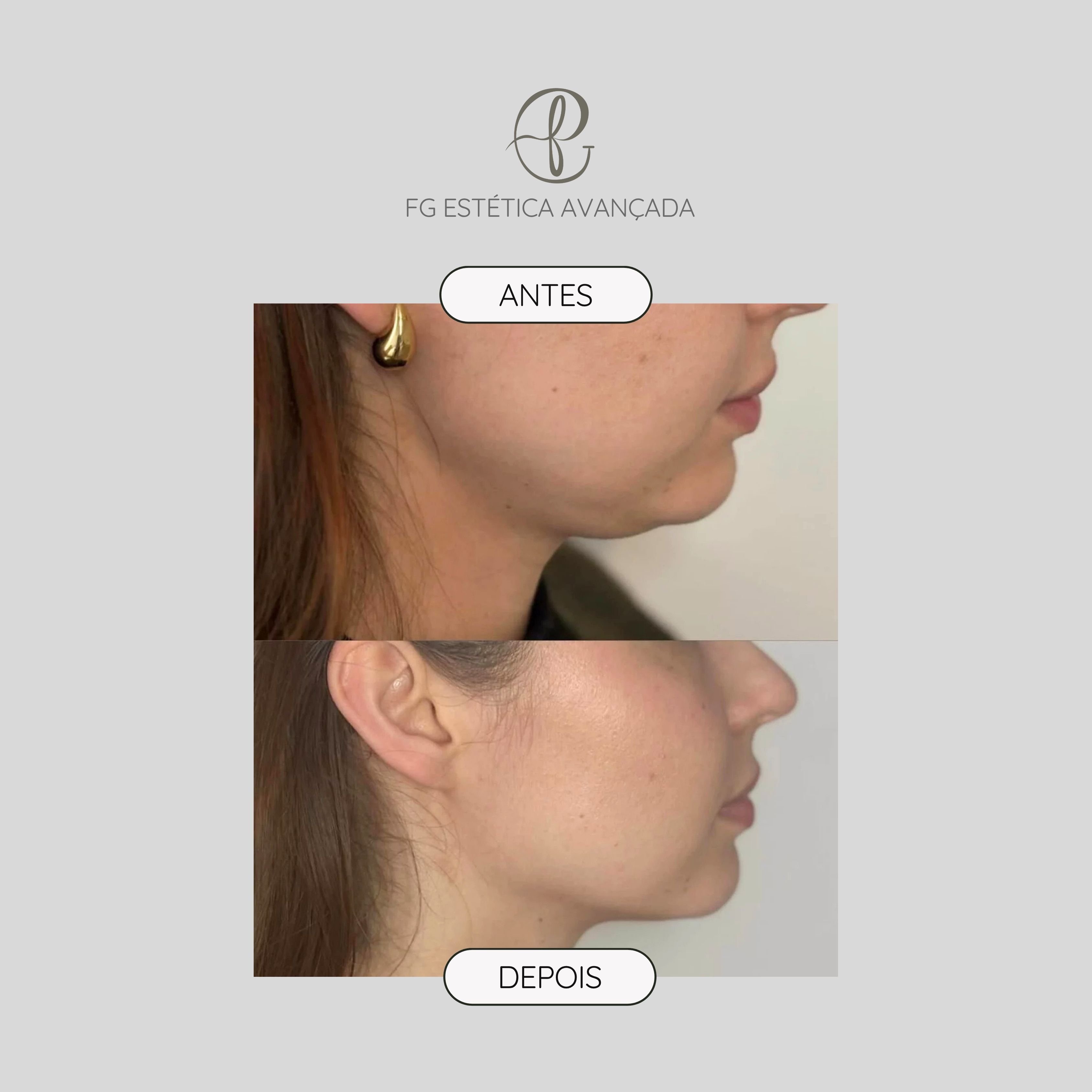 Resultado antes e depois de HIFU — lifting do queixo e contorno facial