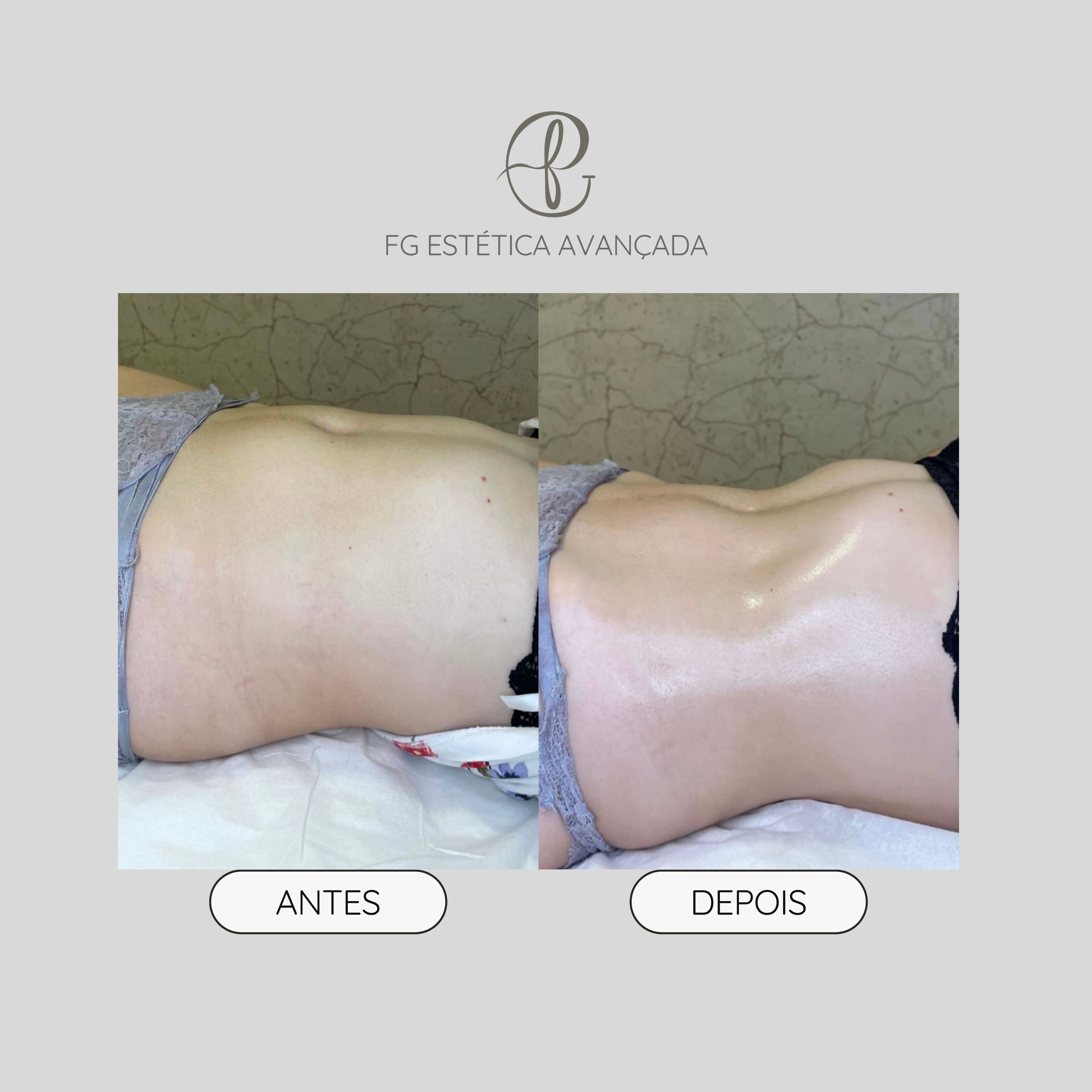 Resultado antes e depois de massagem modeladora — contorno abdominal